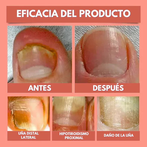 ¡Nuevo! DermaPatch™ Parche Antifúngico para Hongo