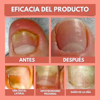 ¡Nuevo! DermaPatch™ Parche Antifúngico para Hongo